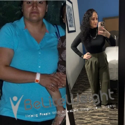 Weight Loss Surgery Gastric Sleeve before and after